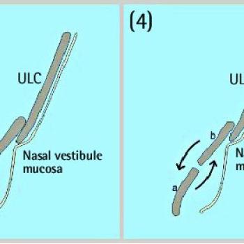 Rinoplastideki tekniğim (CLCA Flap) Dünyanın saygın dergilerinden APS de yayınlandı.